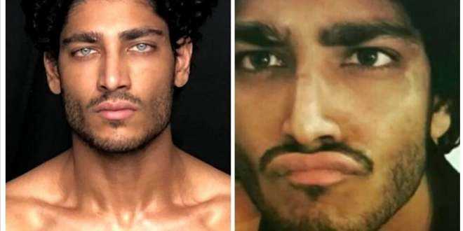 Akash Kumar: ecco qual è la rischiosa operazione agli occhi a cui si sarebbe sottoposto