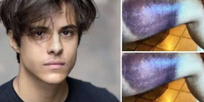 Morte Michele Merlo, spunta la foto di un vistoso livido: “Si poteva salvare”