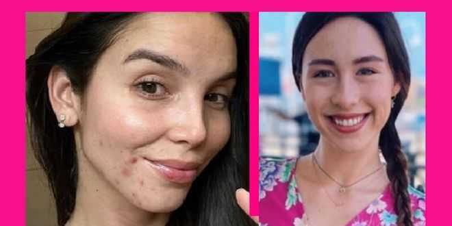 GF Vip, Paola Di Benedetto mostra la pelle sfigurata ed è polemica: interviene Aurora Ramazzotti