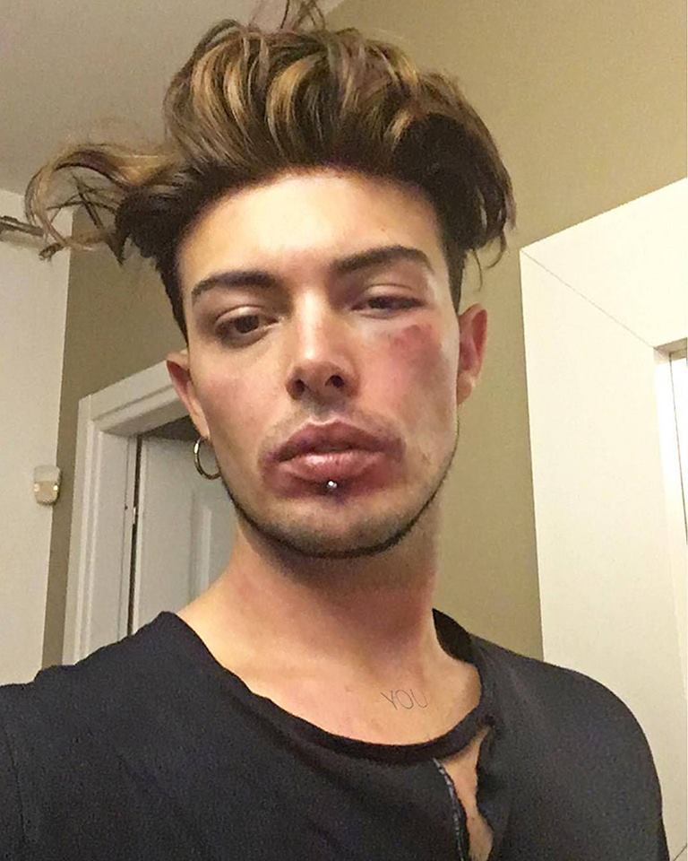 Amici, Stash dei The Colors picchiato a sangue: la foto shock