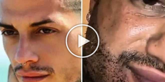 Francesco Chiofalo sfigurato dalla chirurgia: “Mi viene un colpo quando mi guardo”