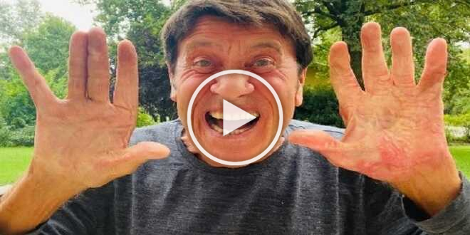 Gianni Morandi, la prima volta senza le bende alle mani: “Voglio urlare”