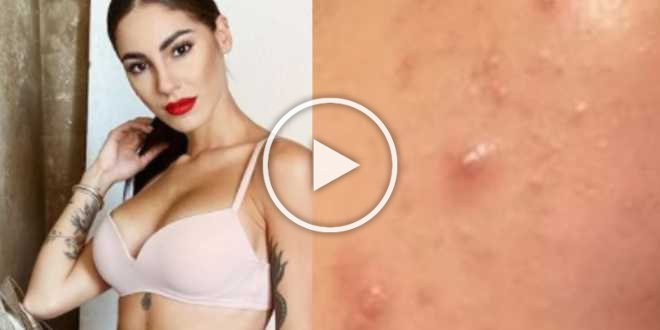 Gossip Uomini e Donne: Giulia De Lellis disperata per l’acne: “Ogni cura fallisce”